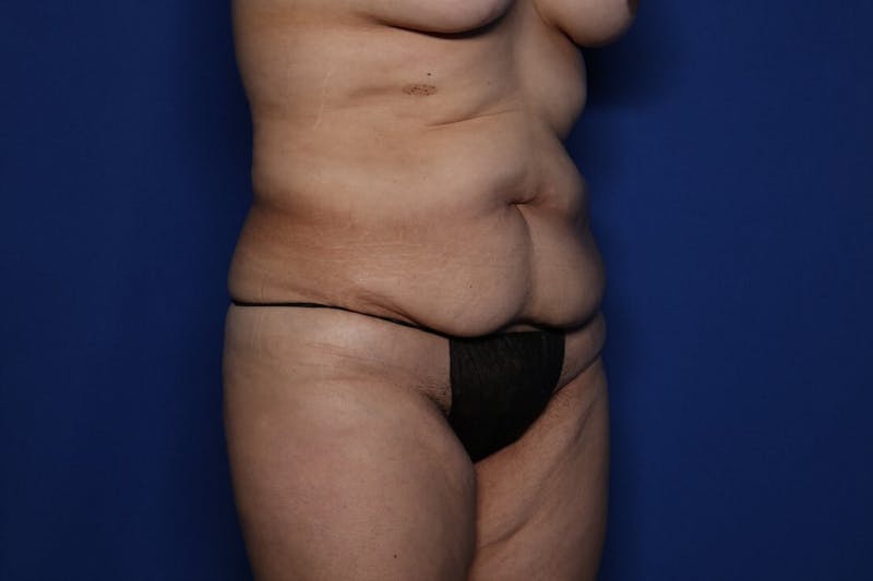 Body Lift Before & After Gallery - Patient 171090 - Image 5