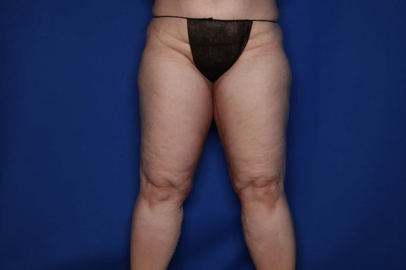 Thigh Lift Before & After Gallery - Patient 307919 - Image 6