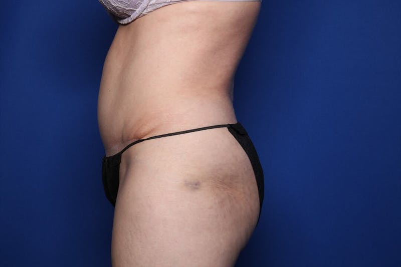 Tummy Tuck Before & After Gallery - Patient 271711 - Image 4