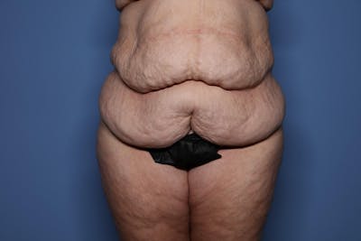 Body Lift Before & After Gallery - Patient 450377 - Image 1