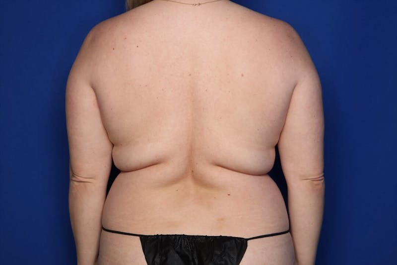 BodyTite™ Before & After Gallery - Patient 397454 - Image 7