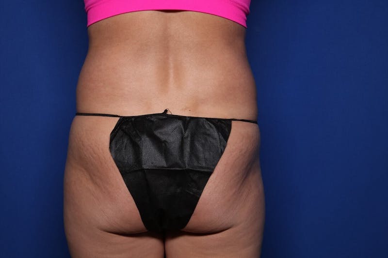 Tummy Tuck Before & After Gallery - Patient 271711 - Image 5