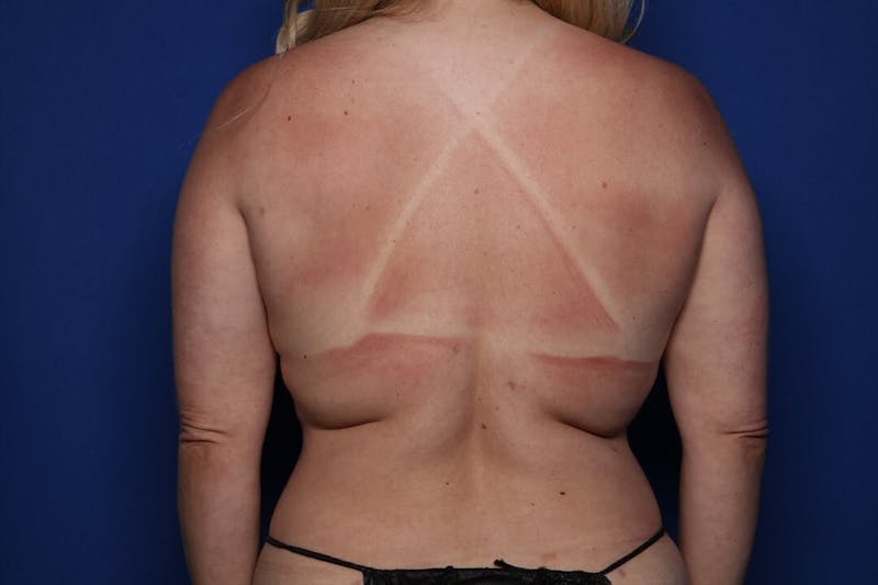 BodyTite™ Before and After Before & After Gallery - Patient 397454 - Image 8