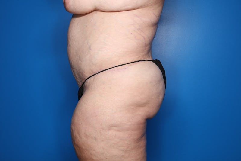 Body Lift Before & After Gallery - Patient 450377 - Image 4