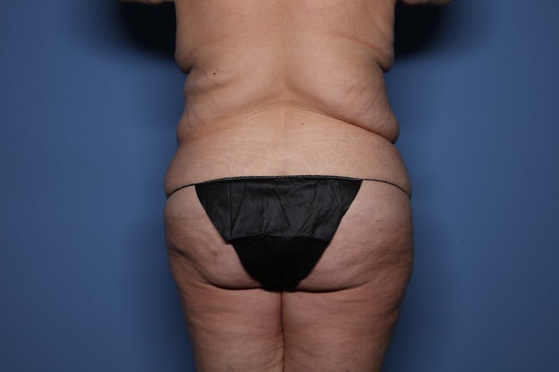 Body Lift Before & After Gallery - Patient 450377 - Image 5