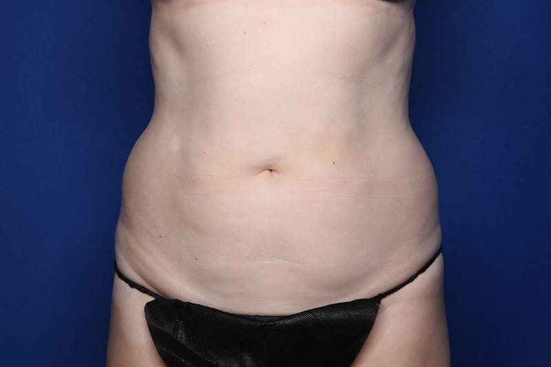 BodyTite™ Before & After Gallery - Patient 307858 - Image 1