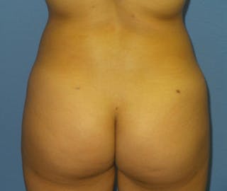 Brazilian Butt Lift Before & After Gallery - Patient 385224 - Image 4