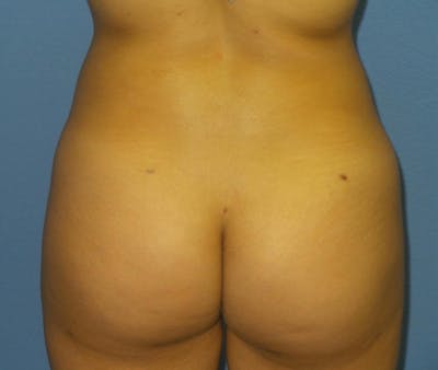 Brazilian Butt Lift Before & After Gallery - Patient 385224 - Image 2