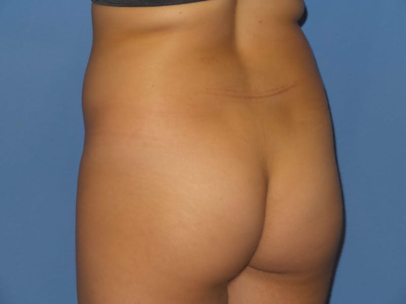 Brazilian Butt Lift Before & After Gallery - Patient 385224 - Image 3