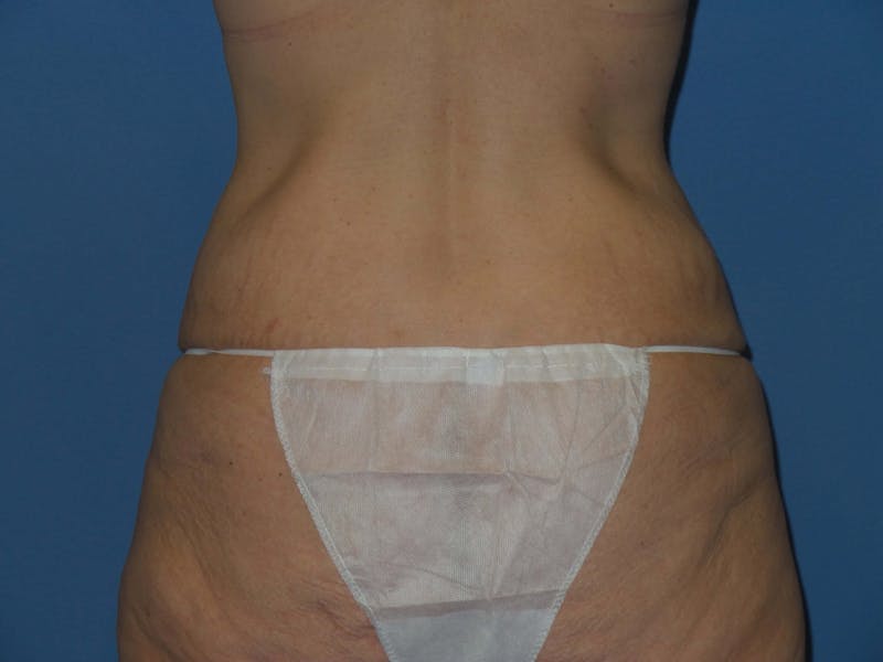 Body Lift Before & After Gallery - Patient 184334 - Image 3