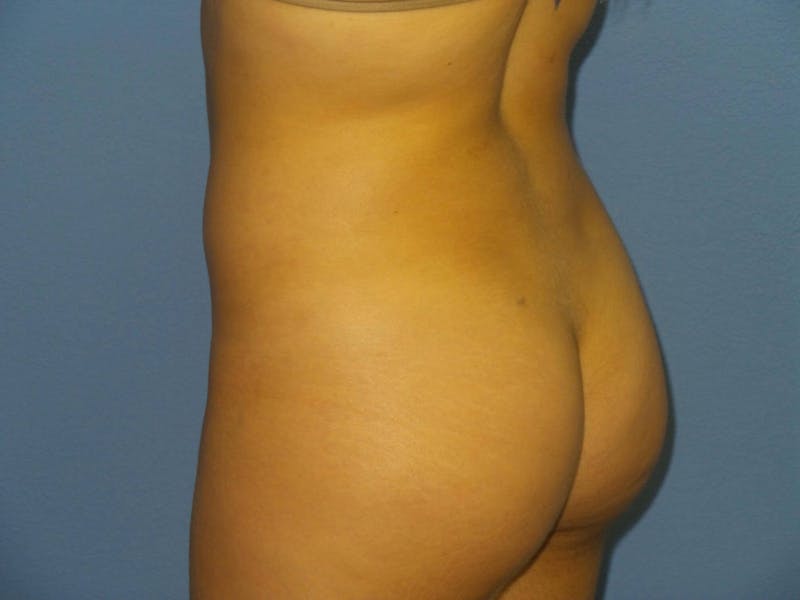 Brazilian Butt Lift Before & After Gallery - Patient 385224 - Image 4