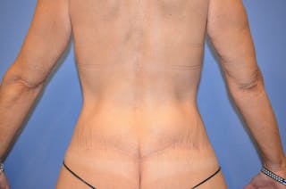 Body Lift Before & After Gallery - Patient 184334 - Image 4