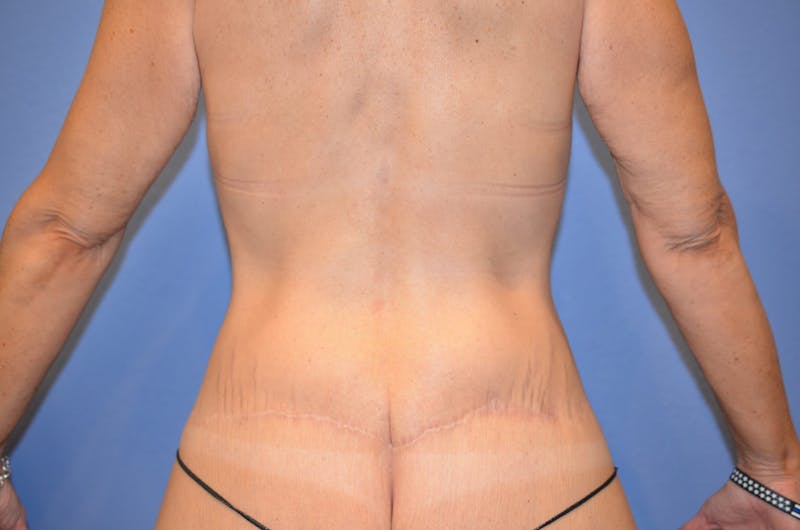 Body Lift Before & After Gallery - Patient 184334 - Image 4