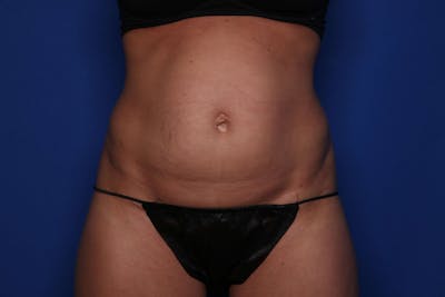 Tummy Tuck Before & After Gallery - Patient 278080 - Image 1