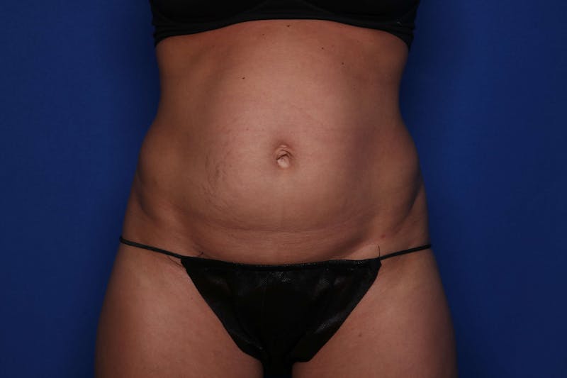 Tummy Tuck Before & After Gallery - Patient 278080 - Image 1