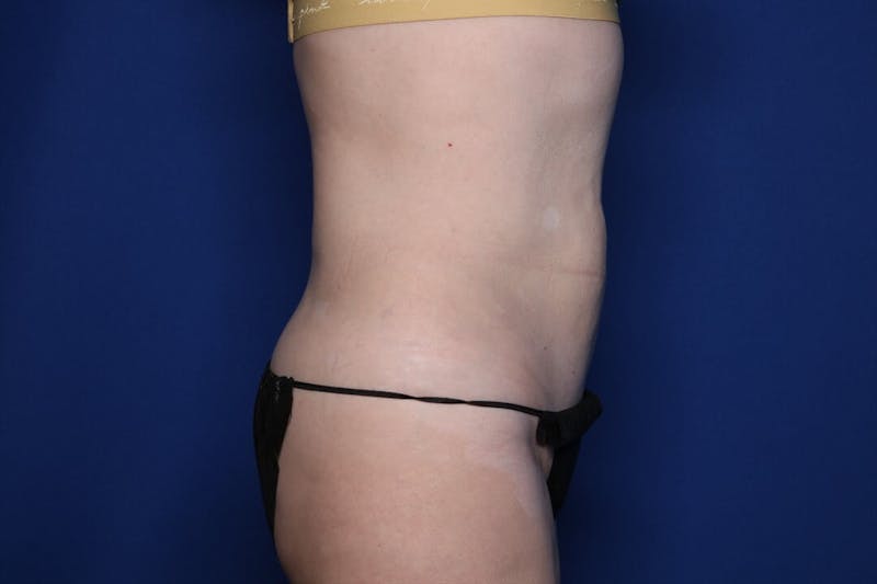 BodyTite™ Before & After Gallery - Patient 307858 - Image 6