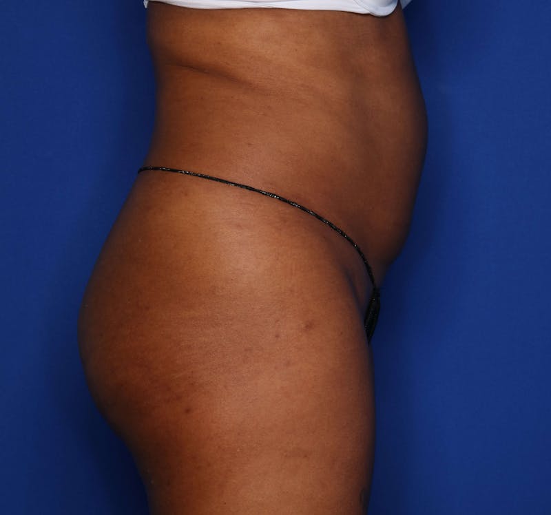 Liposuction Before & After Gallery - Patient 205625 - Image 3