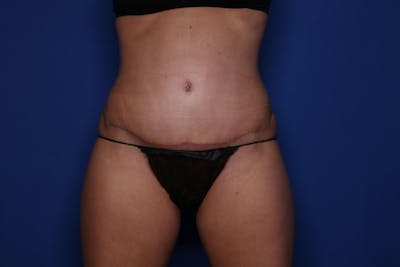 Tummy Tuck Before & After Gallery - Patient 278080 - Image 2