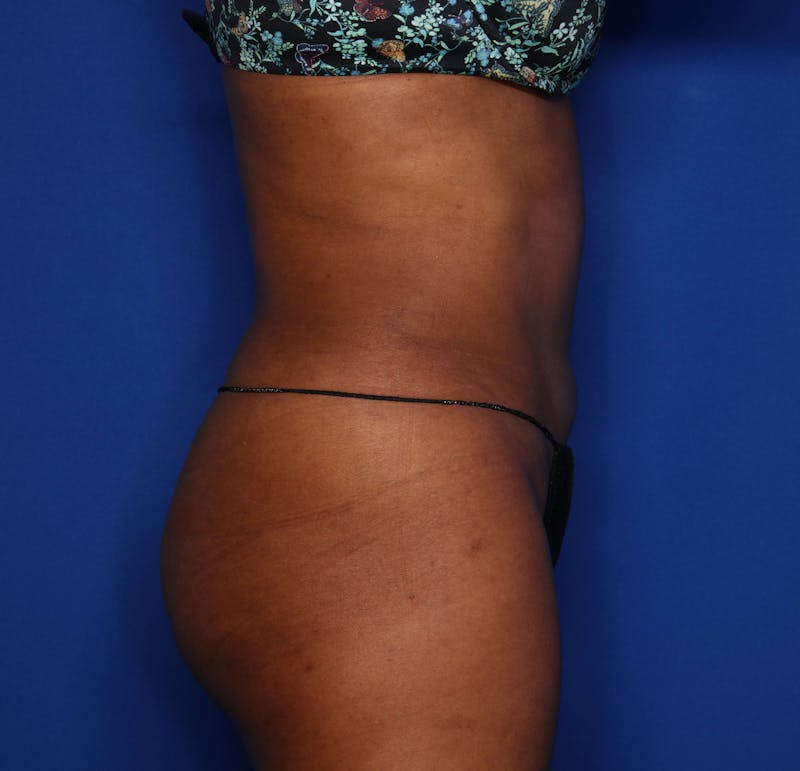 Liposuction Before & After Gallery - Patient 205625 - Image 4
