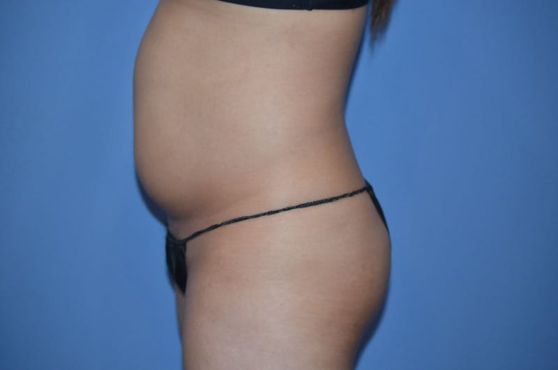 BodyTite™ Before and After Before & After Gallery - Patient 270085 - Image 3