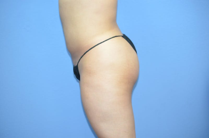 BodyTite™ Before and After Before & After Gallery - Patient 270085 - Image 4