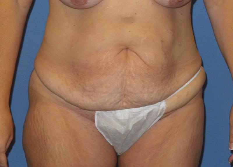Body Lift Before & After Gallery - Patient 466585 - Image 3