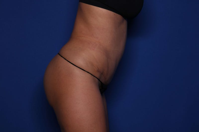 Tummy Tuck Before & After Gallery - Patient 278080 - Image 4