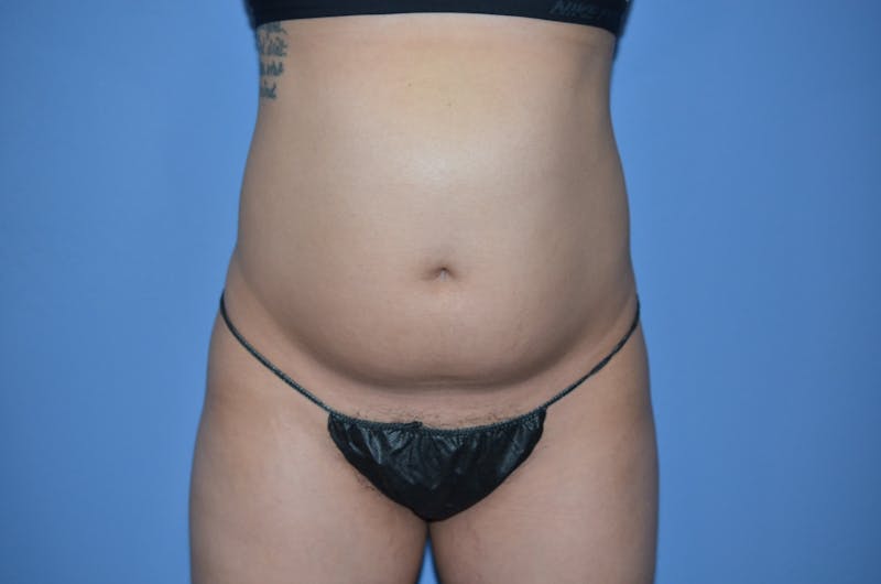 BodyTite™ Before & After Gallery - Patient 270085 - Image 5