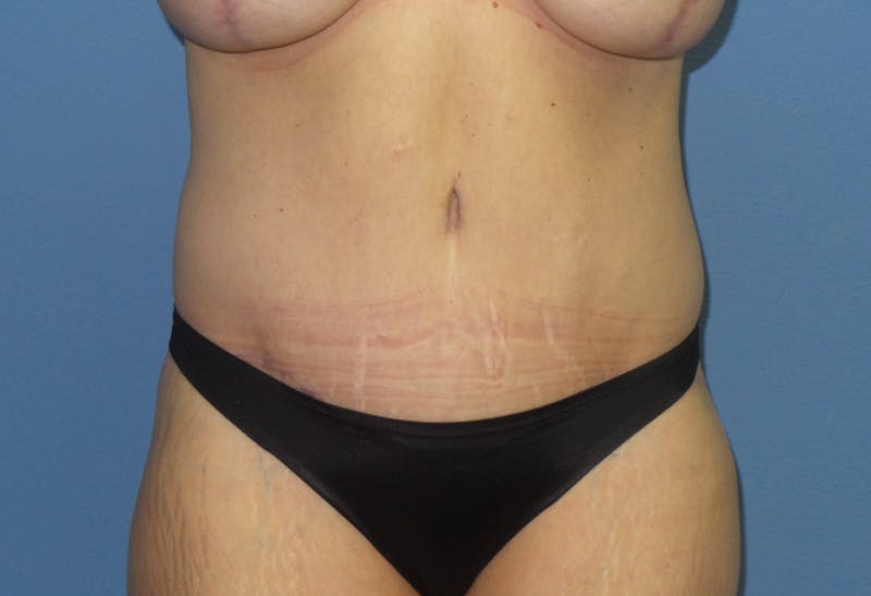 Body Lift Before & After Gallery - Patient 466585 - Image 4