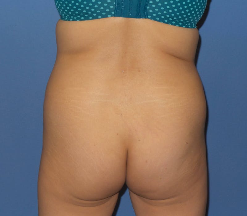 Brazilian Butt Lift Before & After Gallery - Patient 367040 - Image 3