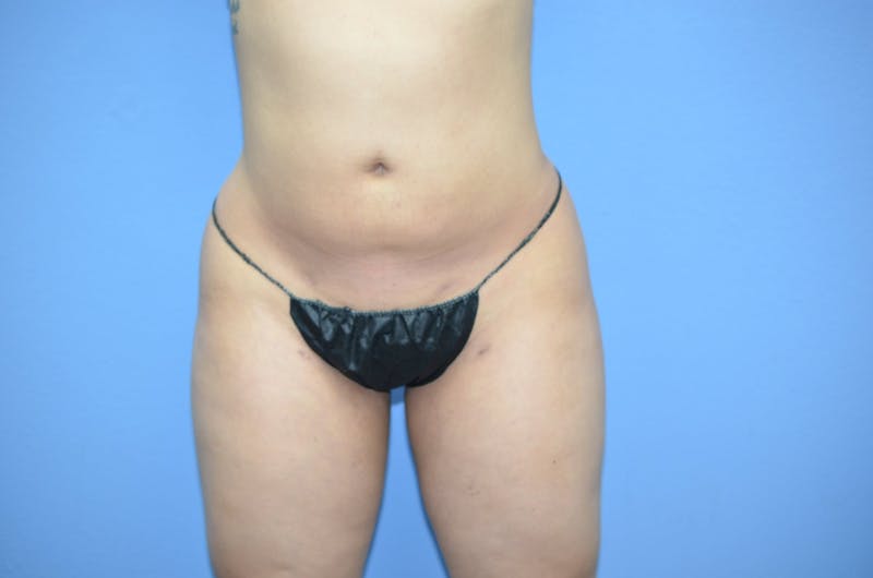 BodyTite™ Before & After Gallery - Patient 270085 - Image 6
