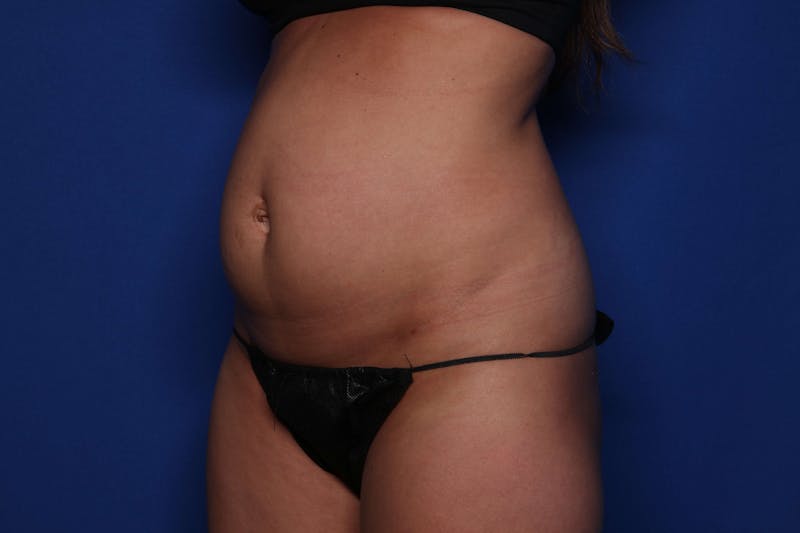Tummy Tuck Before & After Gallery - Patient 278080 - Image 5