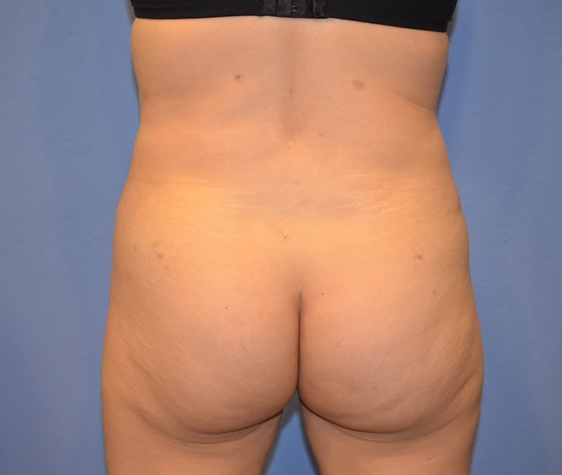 Brazilian Butt Lift Before & After Gallery - Patient 367040 - Image 4