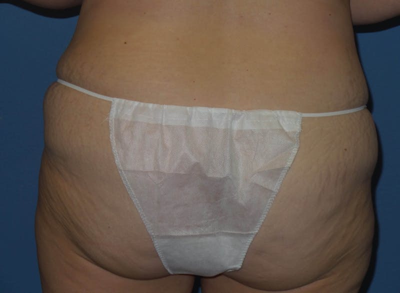 Body Lift Before & After Gallery - Patient 466585 - Image 5