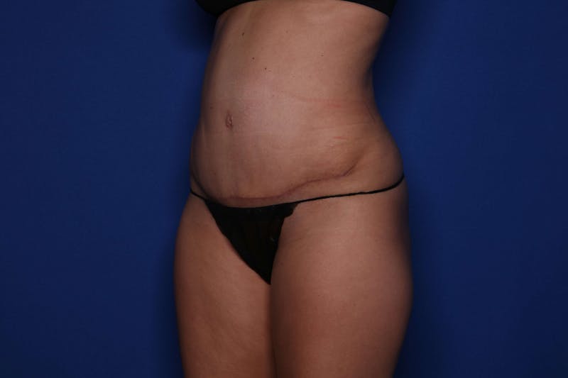Tummy Tuck Before & After Gallery - Patient 278080 - Image 6