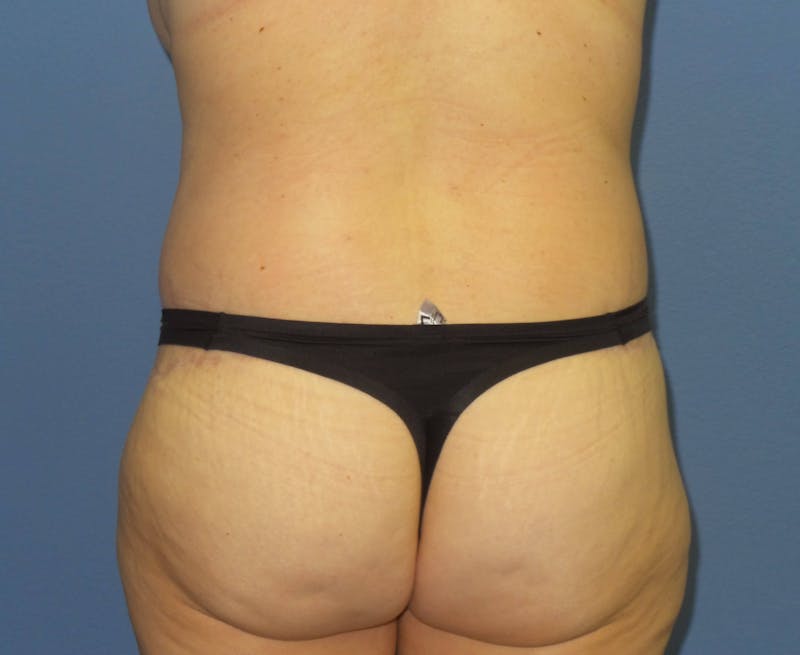 Body Lift Before & After Gallery - Patient 466585 - Image 6