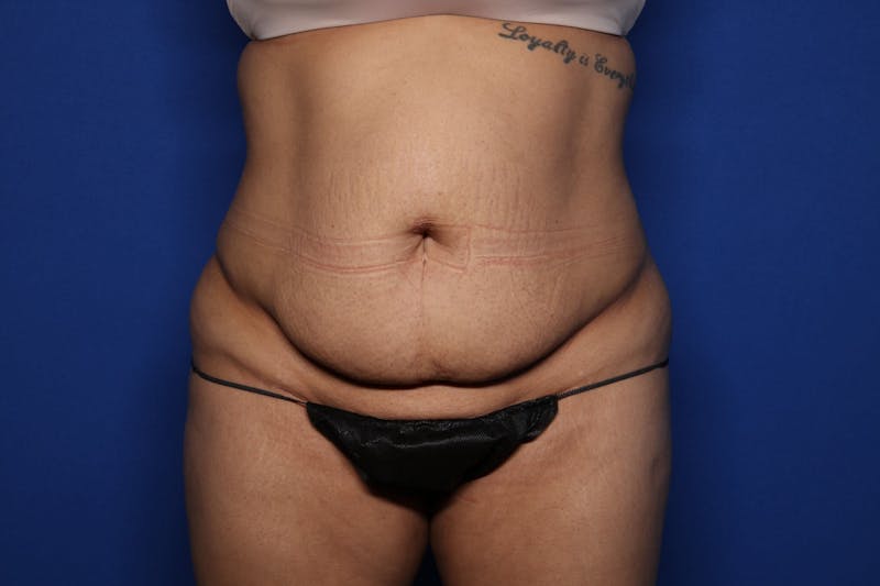 Liposuction Before & After Gallery - Patient 578853 - Image 1