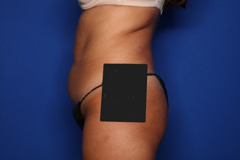 BodyTite™ Before and After Before & After Gallery - Patient 191387 - Image 3
