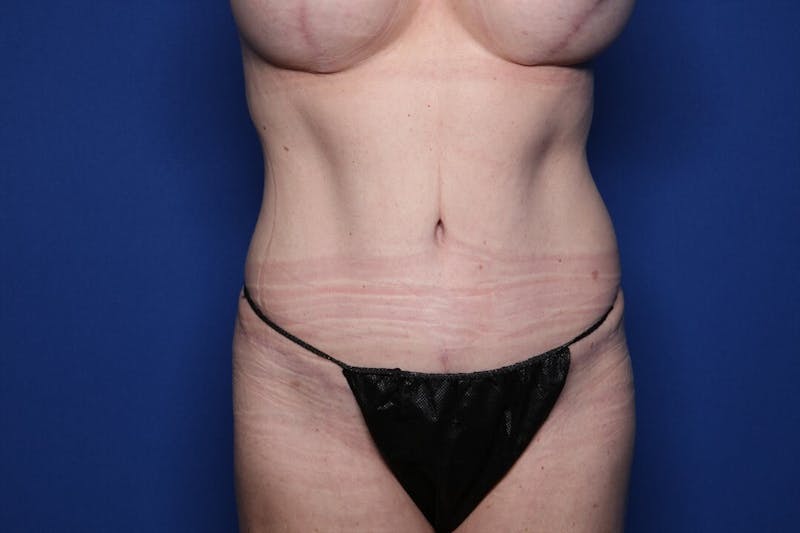 Mommy Makeover Before & After Gallery - Patient 372987 - Image 4