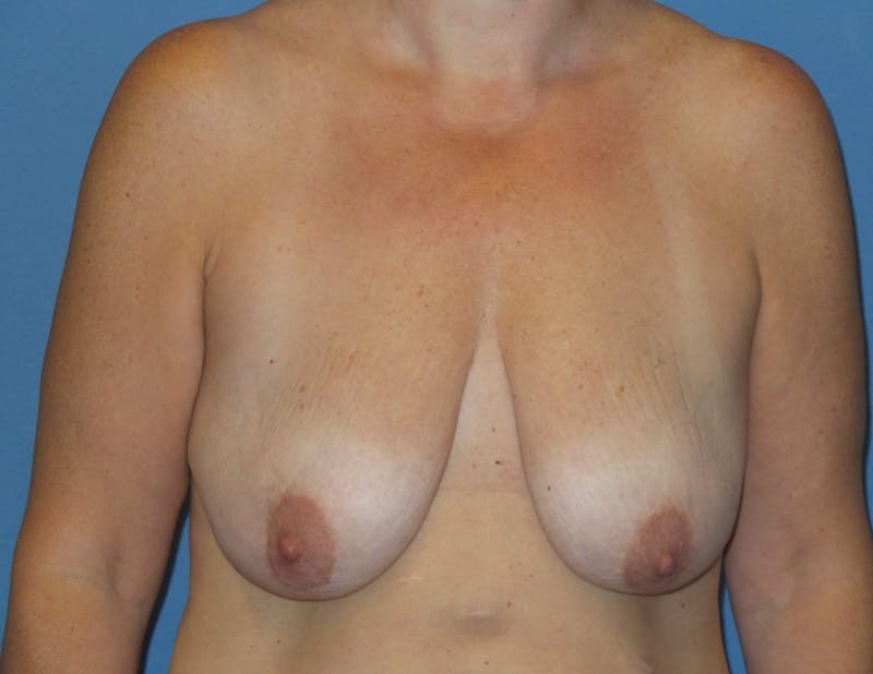Body Lift Before & After Gallery - Patient 466585 - Image 7