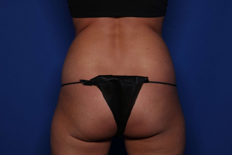 Tummy Tuck Before & After Gallery - Patient 278080 - Image 7