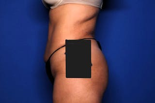 BodyTite™ Before and After Before & After Gallery - Patient 191387 - Image 4