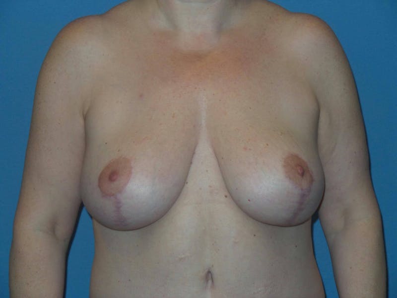 Body Lift Before & After Gallery - Patient 466585 - Image 8