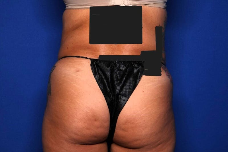 BodyTite™ Before & After Gallery - Patient 191387 - Image 6