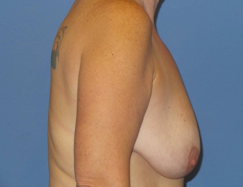 Body Lift Before & After Gallery - Patient 466585 - Image 9