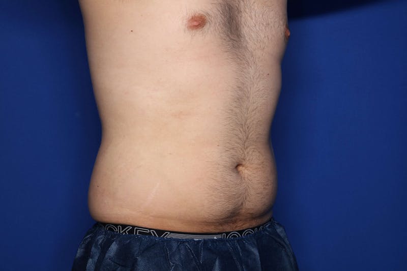 BodyTite™ Before & After Gallery - Patient 377139 - Image 1