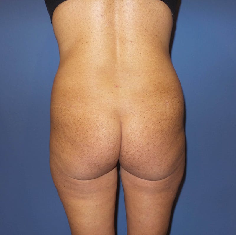 Brazilian Butt Lift Before & After Gallery - Patient 158798 - Image 3