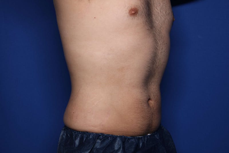 BodyTite™ Before & After Gallery - Patient 377139 - Image 2