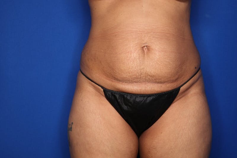 Tummy Tuck Before & After Gallery - Patient 383997 - Image 1