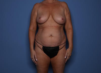 Mommy Makeover Before & After Gallery - Patient 929850 - Image 1